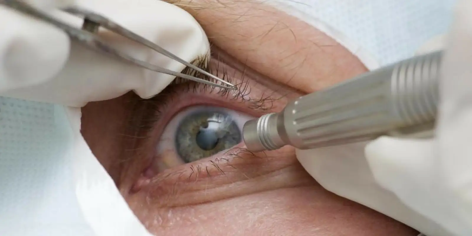 Médicos alertam sobre riscos de cirurgia para mudar cor dos olhos, febre entre influenciadores