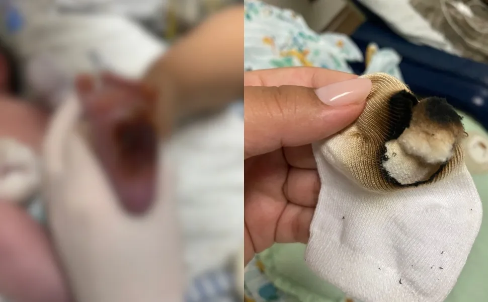 Funcionários são afastados após bebê ter pé queimado em hospital na Serra